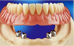 fogorvos, fogászat, fogászat pécs, eurodental, szájsebészet, teleszkóp, implant