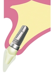 implant, dental implant, implantátum, implantatum pecs, implantátum pécs