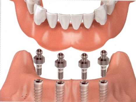 overdenture, fogpotlas, minőségi fogászat, pécs, fogorvos pecs, fogorvospécs, mini implant pecs